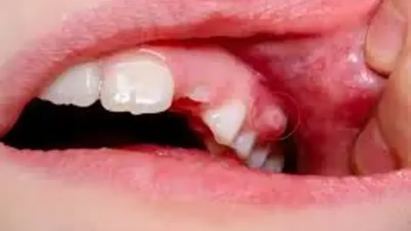 Practical Ways to Alleviate Tooth Abscess Pain Quickly